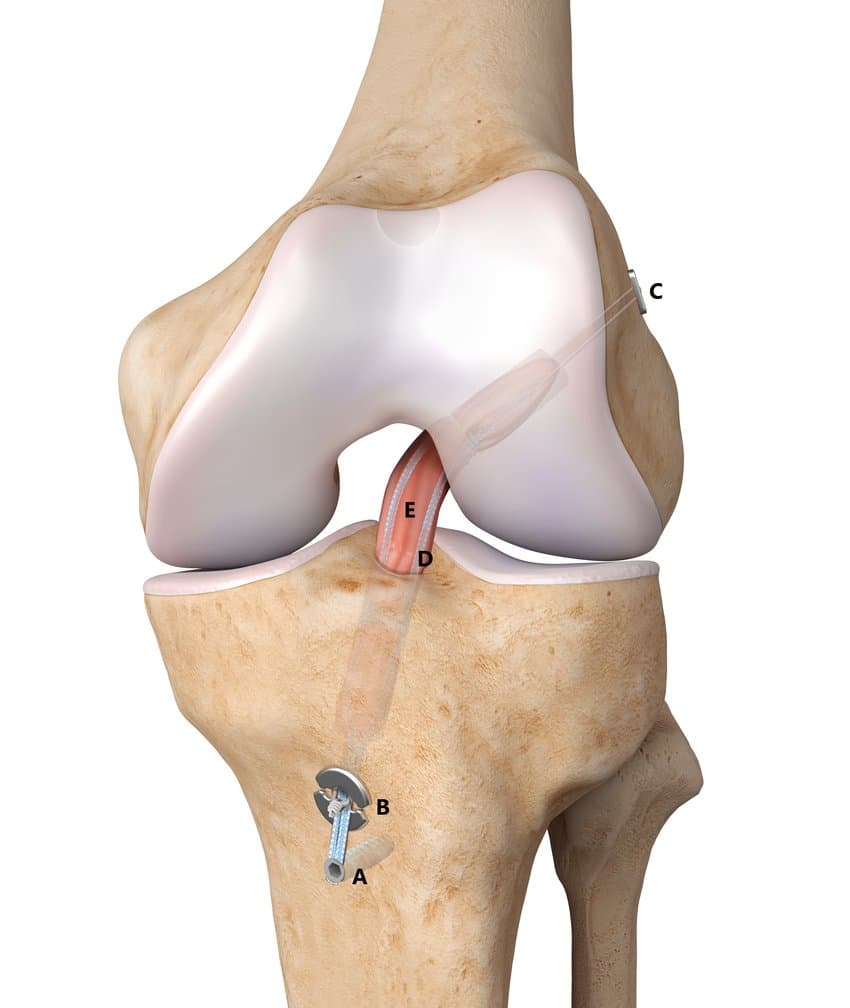 vue 3D anatomie du genou opere