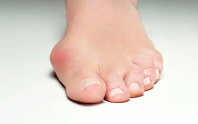 Récupération après chirurgie de l’hallux valgus