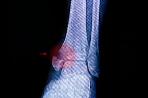 radio d'une fracture cheville avec une flèche rouge qui montre l'os cassé